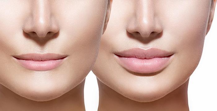Hoy en nuestro blog te lo contamos todo sobre Hyaluron Pen el nuevo tratamiento estético avanzado con el que aumentar tus labios sin agujas